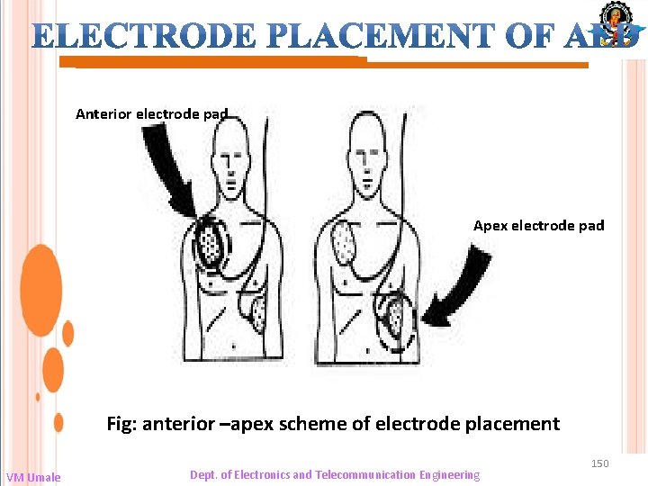 Anterior electrode pad Apex electrode pad Fig: anterior –apex scheme of electrode placement VM