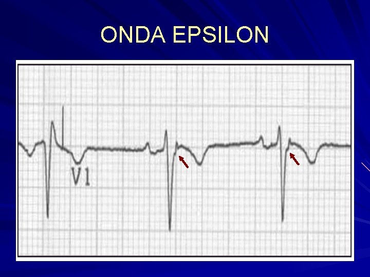ONDA EPSILON ONDA EPSILON