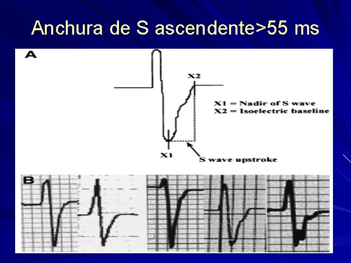Anchura de S ascendente>55 ms Anchura de S ascendente>55 ms