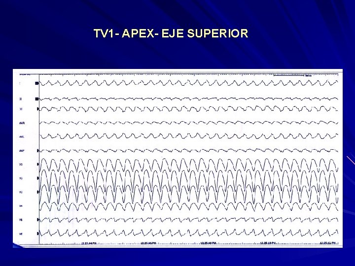 TV 1 - APEX- EJE SUPERIOR TV 1 - APEX- EJE SUPERIOR