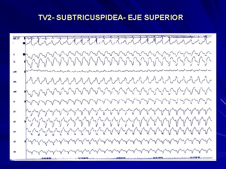 TV 2 - SUBTRICUSPIDEA- EJE SUPERIOR TV 2 - SUBTRICUSPIDEA- EJE SUPERIOR