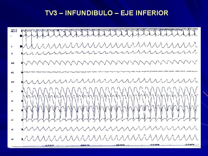 TV 3 – INFUNDIBULO – EJE INFERIOR TV 3 – INFUNDIBULO – EJE INFERIOR