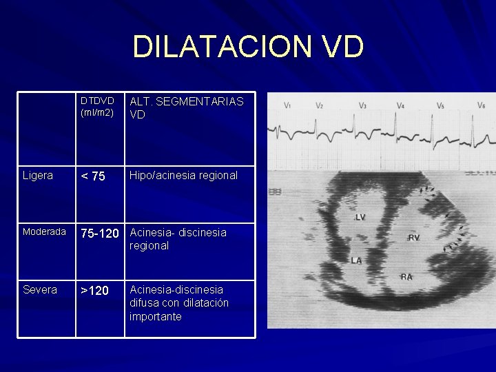 DILATACION VD DTDVD (ml/m 2) ALT. SEGMENTARIAS VD Ligera < 75 Hipo/acinesia regional Moderada DILATACION VD DTDVD (ml/m 2) ALT. SEGMENTARIAS VD Ligera < 75 Hipo/acinesia regional Moderada