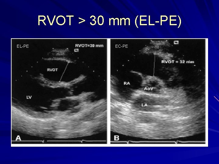 RVOT > 30 mm (EL-PE) EL-PE EC-PE RVOT > 30 mm (EL-PE) EL-PE EC-PE