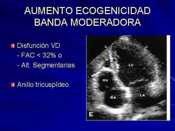 AUMENTO ECOGENICIDAD BANDA MODERADORA Disfunción VD - FAC < 32% o - Alt. Segmentarias AUMENTO ECOGENICIDAD BANDA MODERADORA Disfunción VD - FAC < 32% o - Alt. Segmentarias