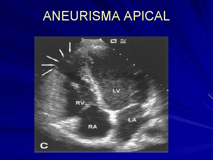 ANEURISMA APICAL ANEURISMA APICAL