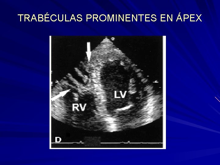 TRABÉCULAS PROMINENTES EN ÁPEX TRABÉCULAS PROMINENTES EN ÁPEX