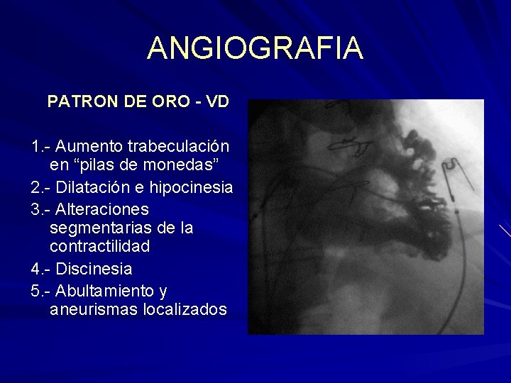 ANGIOGRAFIA PATRON DE ORO - VD 1. - Aumento trabeculación en “pilas de monedas” ANGIOGRAFIA PATRON DE ORO - VD 1. - Aumento trabeculación en “pilas de monedas”