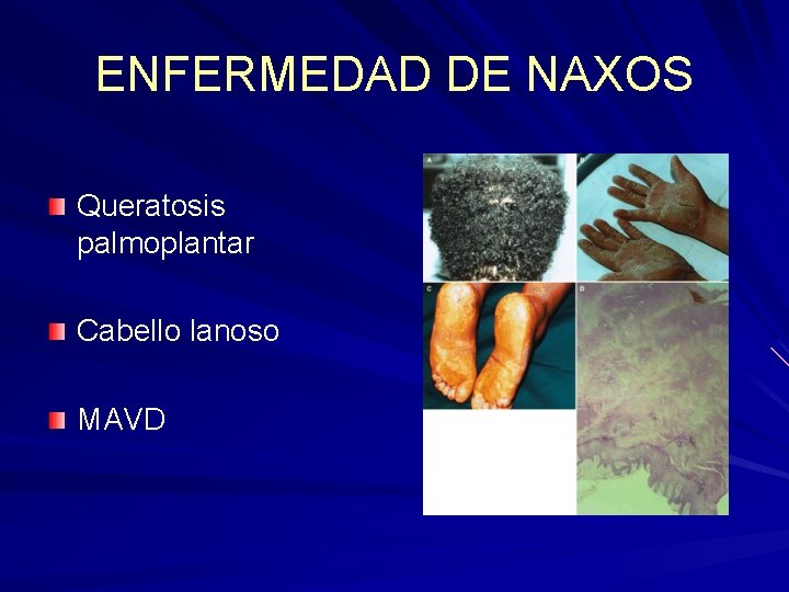 ENFERMEDAD DE NAXOS Queratosis palmoplantar Cabello lanoso MAVD ENFERMEDAD DE NAXOS Queratosis palmoplantar Cabello lanoso MAVD