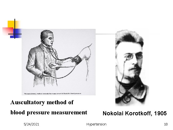 Auscultatory method of blood pressure measurement 5/24/2021 Nokolai Korotkoff, 1905 Hypertension 18 