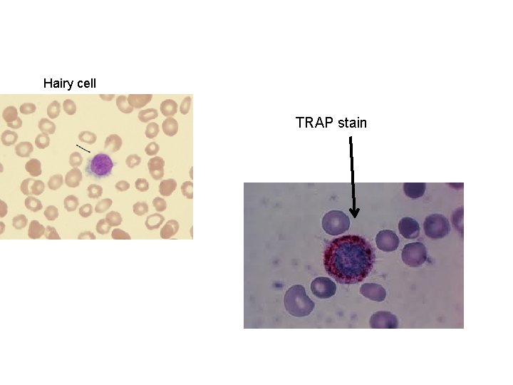 Hairy cell TRAP stain 