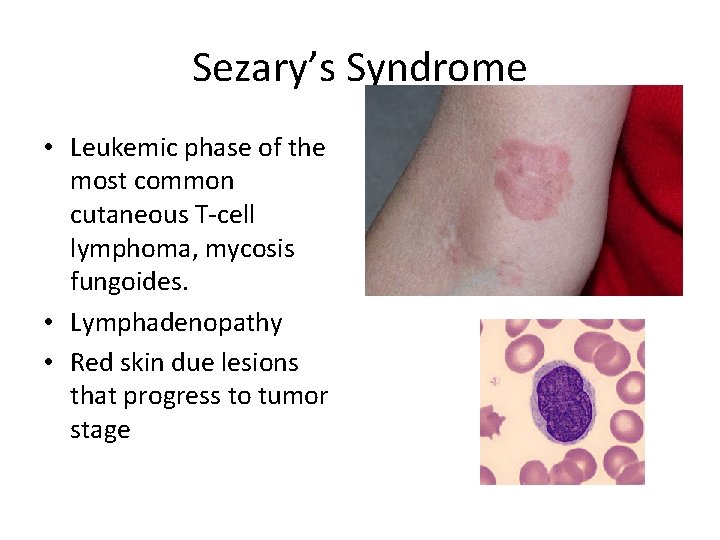Sezary’s Syndrome • Leukemic phase of the most common cutaneous T-cell lymphoma, mycosis fungoides.