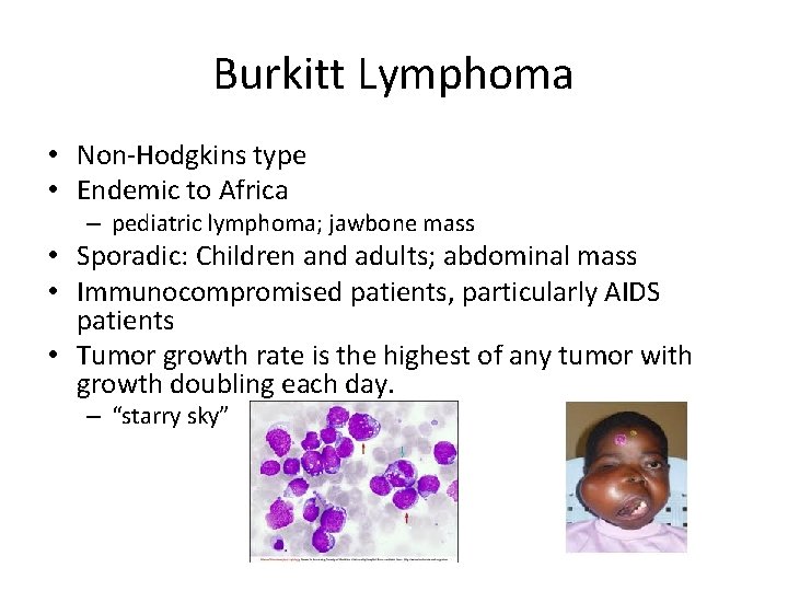 Burkitt Lymphoma • Non-Hodgkins type • Endemic to Africa – pediatric lymphoma; jawbone mass