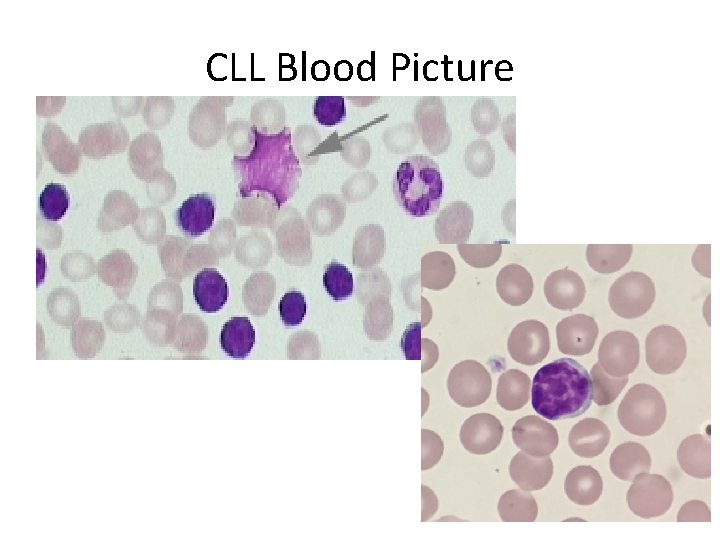 CLL Blood Picture 