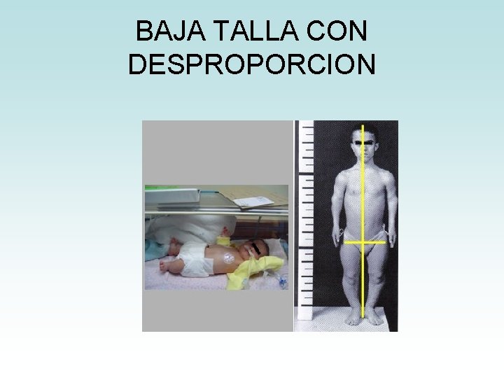 BAJA TALLA CON DESPROPORCION BAJA TALLA CON DESPROPORCION