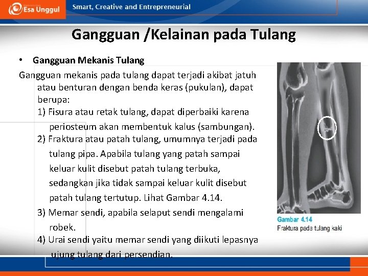 Gangguan /Kelainan pada Tulang • Gangguan Mekanis Tulang Gangguan mekanis pada tulang dapat terjadi