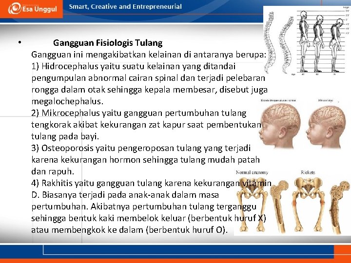  • Gangguan Fisiologis Tulang Gangguan ini mengakibatkan kelainan di antaranya berupa: 1) Hidrocephalus