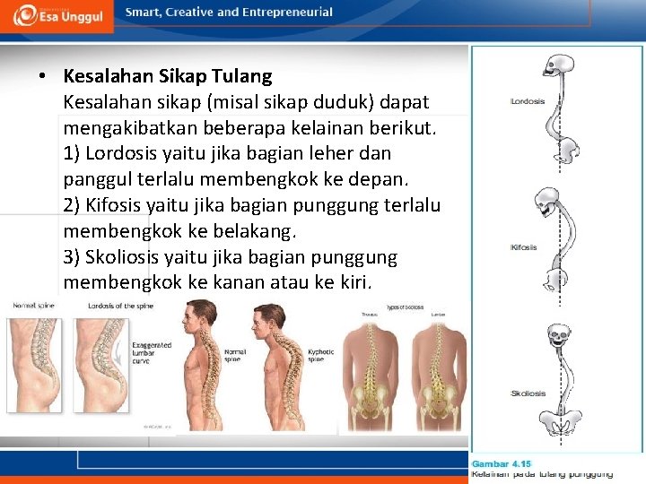  • Kesalahan Sikap Tulang Kesalahan sikap (misal sikap duduk) dapat mengakibatkan beberapa kelainan