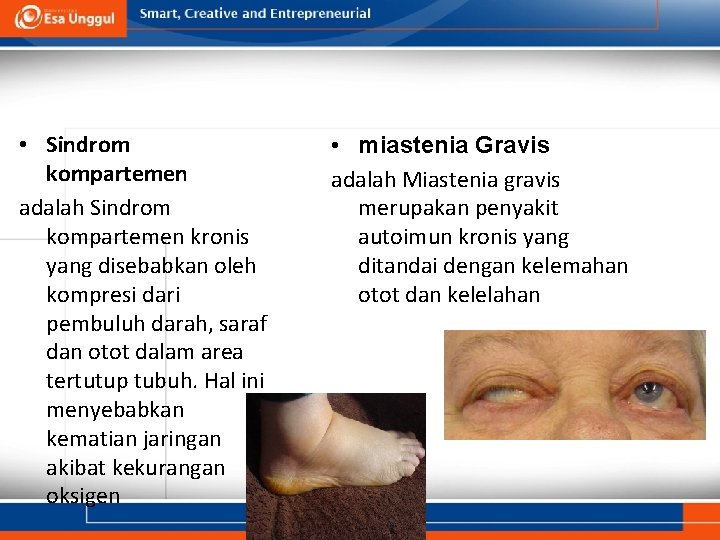  • Sindrom kompartemen adalah Sindrom kompartemen kronis yang disebabkan oleh kompresi dari pembuluh