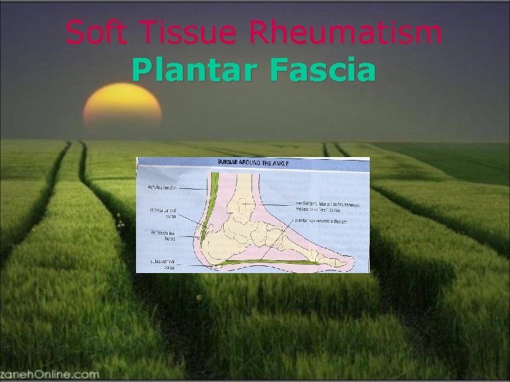 Soft Tissue Rheumatism Plantar Fascia 