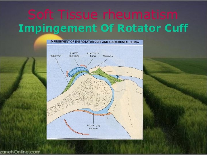 Soft Tissue rheumatism Impingement Of Rotator Cuff 