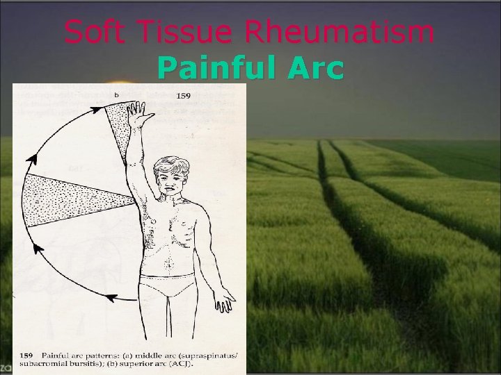 Soft Tissue Rheumatism Painful Arc 