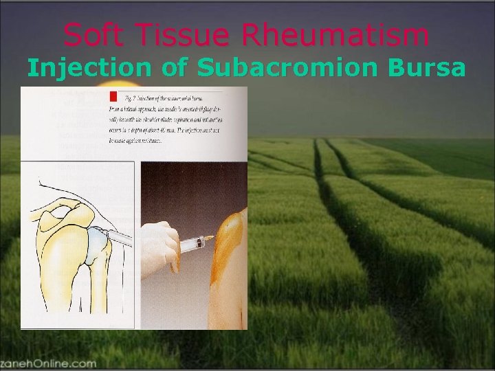 Soft Tissue Rheumatism Injection of Subacromion Bursa 