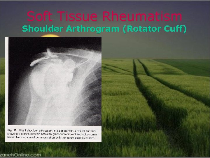 Soft Tissue Rheumatism Shoulder Arthrogram (Rotator Cuff) 