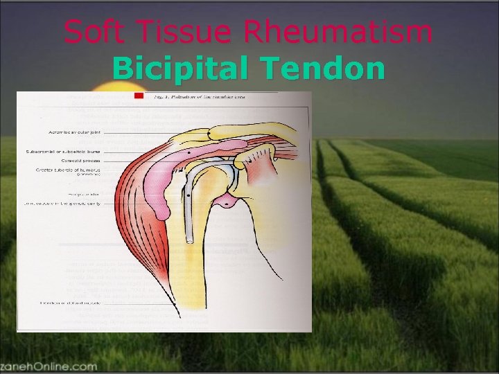 Soft Tissue Rheumatism Bicipital Tendon 