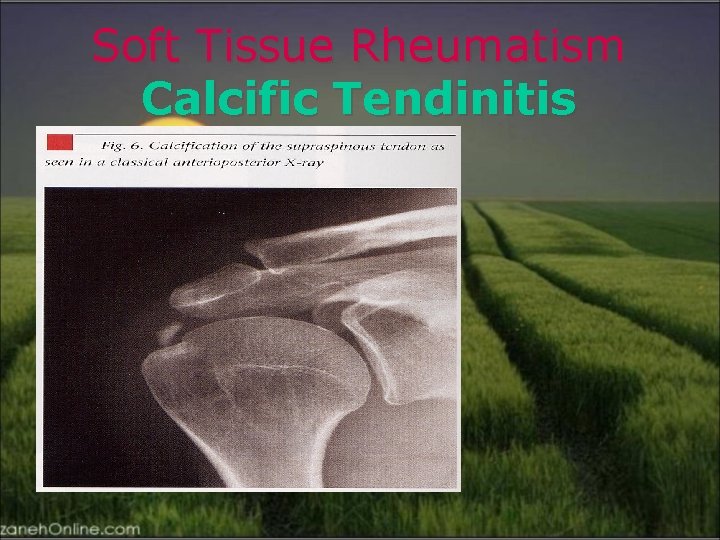 Soft Tissue Rheumatism Calcific Tendinitis 