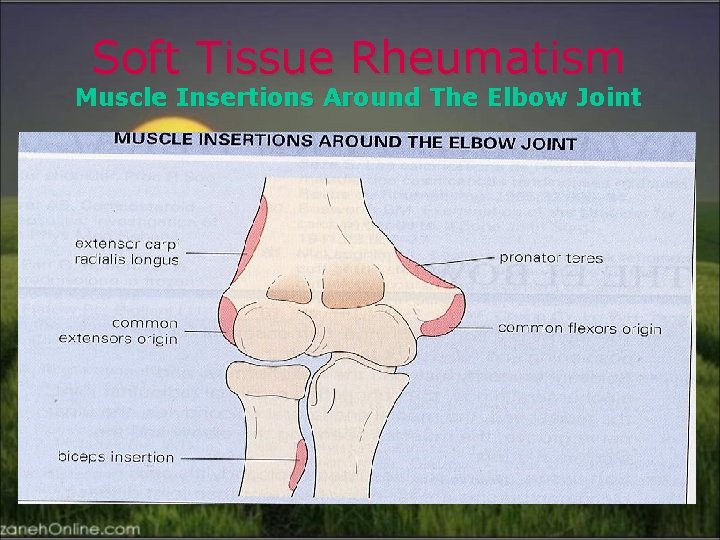 Soft Tissue Rheumatism Muscle Insertions Around The Elbow Joint 