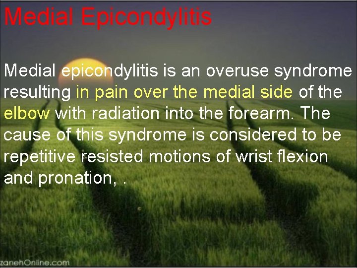 Medial Epicondylitis Medial epicondylitis is an overuse syndrome resulting in pain over the medial