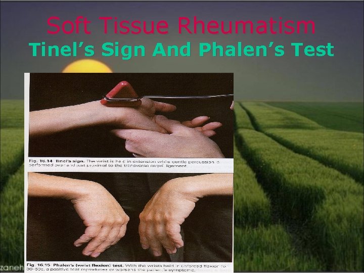 Soft Tissue Rheumatism Tinel’s Sign And Phalen’s Test 