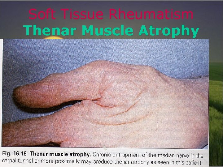 Soft Tissue Rheumatism Thenar Muscle Atrophy 