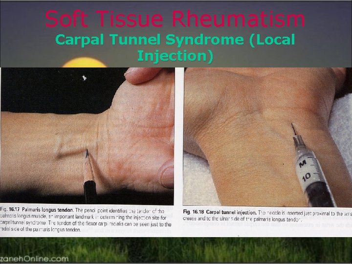 Soft Tissue Rheumatism Carpal Tunnel Syndrome (Local Injection) 