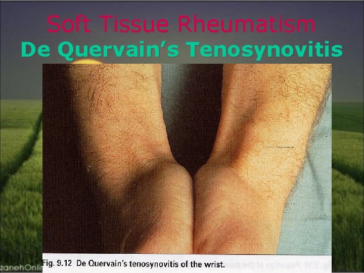 Soft Tissue Rheumatism De Quervain’s Tenosynovitis 