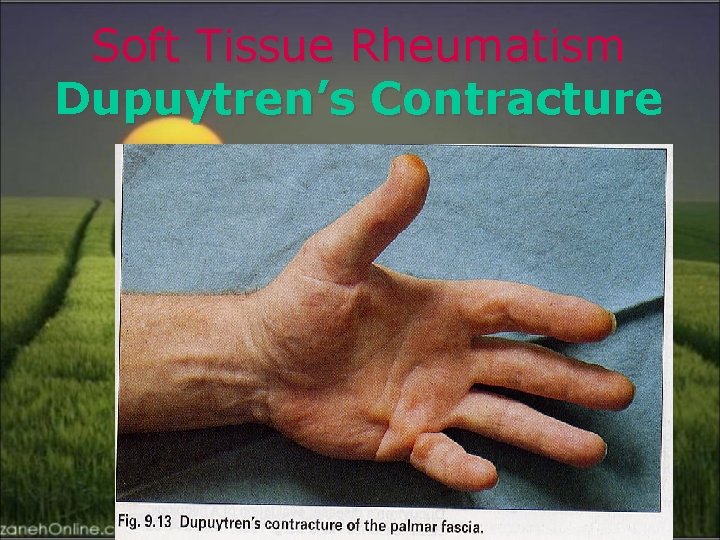 Soft Tissue Rheumatism Dupuytren’s Contracture 