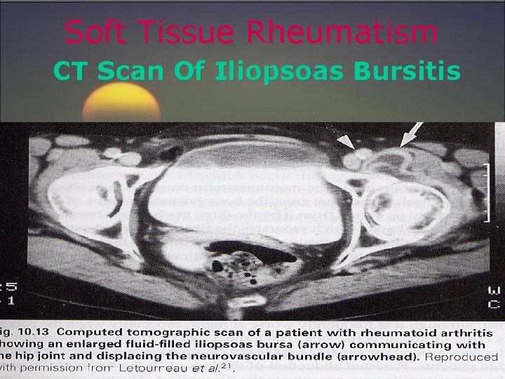 Soft Tissue Rheumatism CT Scan Of Iliopsoas Bursitis 