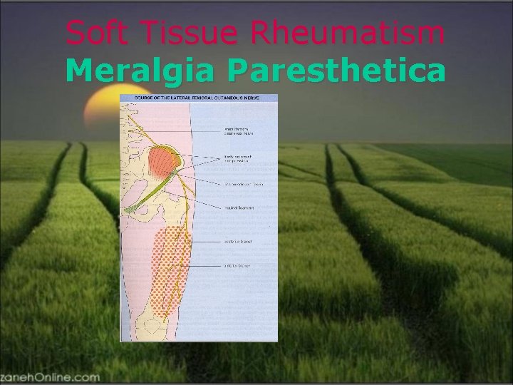 Soft Tissue Rheumatism Meralgia Paresthetica 