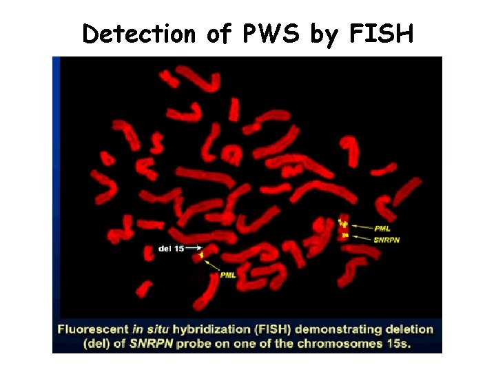 Detection of PWS by FISH 