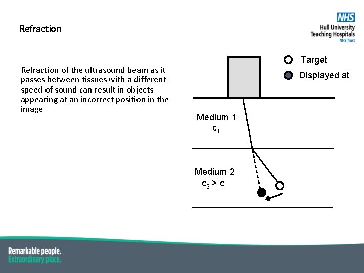 Refraction of the ultrasound beam as it passes between tissues with a different speed