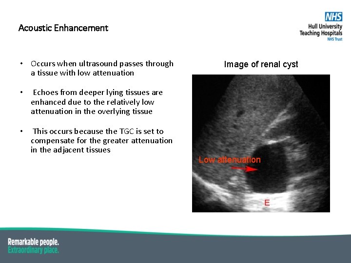 Acoustic Enhancement • Occurs when ultrasound passes through a tissue with low attenuation •