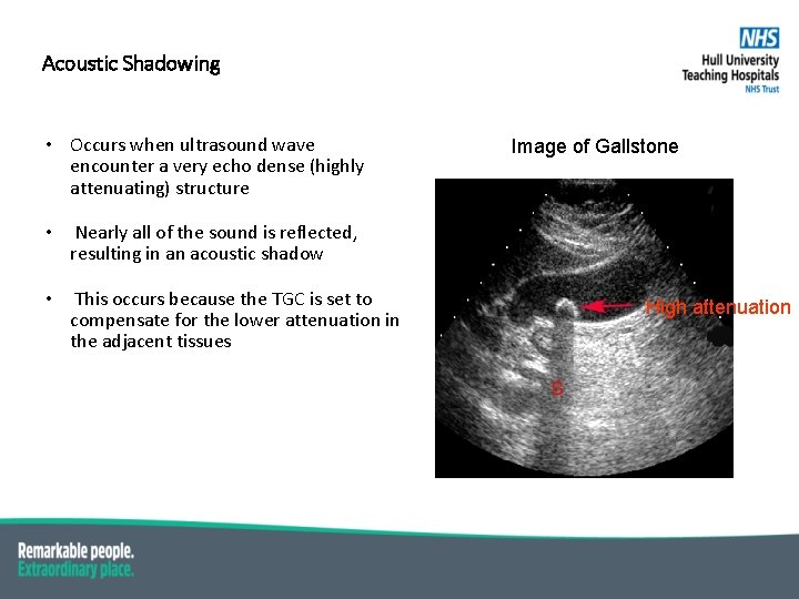 Acoustic Shadowing • Occurs when ultrasound wave encounter a very echo dense (highly attenuating)