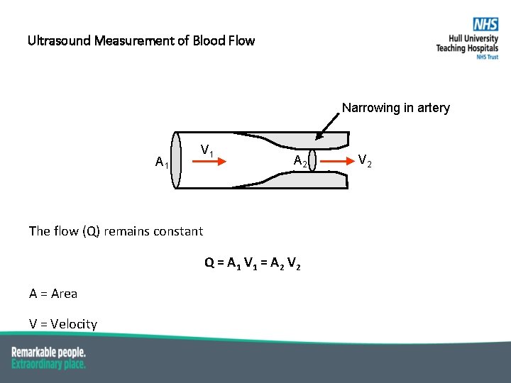 Ultrasound Measurement of Blood Flow Narrowing in artery A 1 V 1 A 2