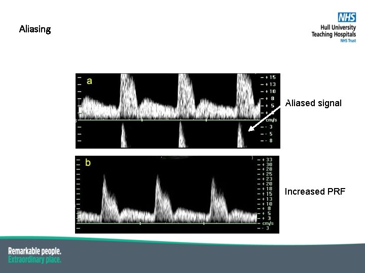 Aliasing Aliased signal Increased PRF 