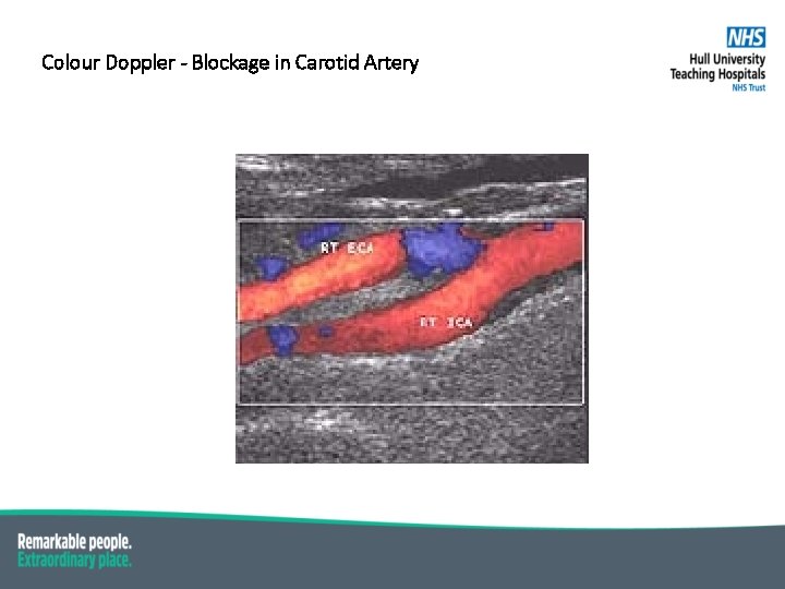 Colour Doppler - Blockage in Carotid Artery 