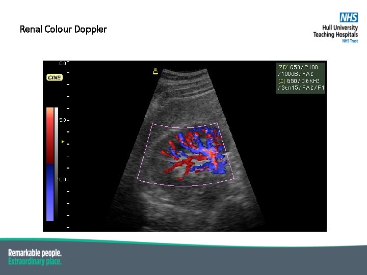 Renal Colour Doppler 