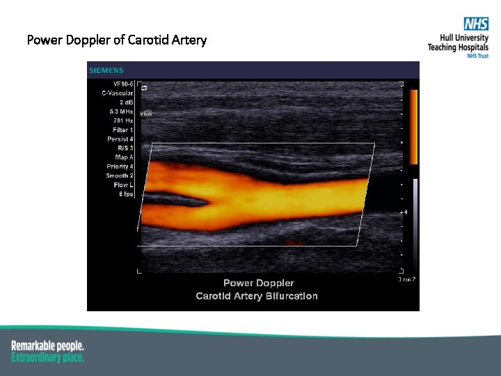 Power Doppler of Carotid Artery Suspicious dark lesion 