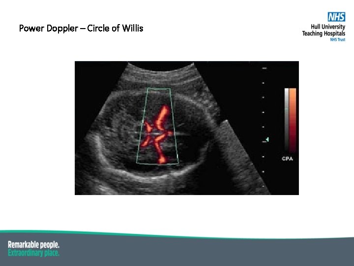 Power Doppler – Circle of Willis Suspicious dark lesion 