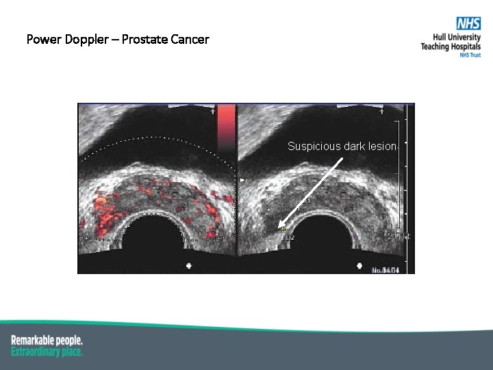 Power Doppler – Prostate Cancer Suspicious dark lesion 